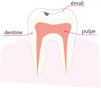 Schéma d'une dent en vue de coupe représentant l'étape 1 d'une carie