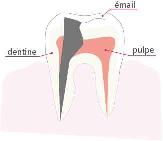 Schéma d'une dent en vue de coupe représentant l'étape 4 d'une carie