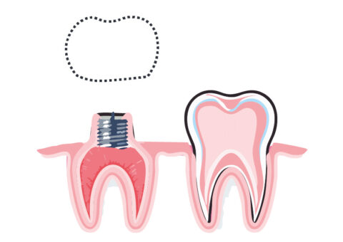 L’inlay-core : une solution solide pour restaurer les dents endommagées ...